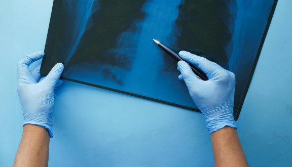 X-ray of lungs