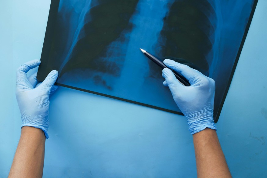 X-ray of lungs