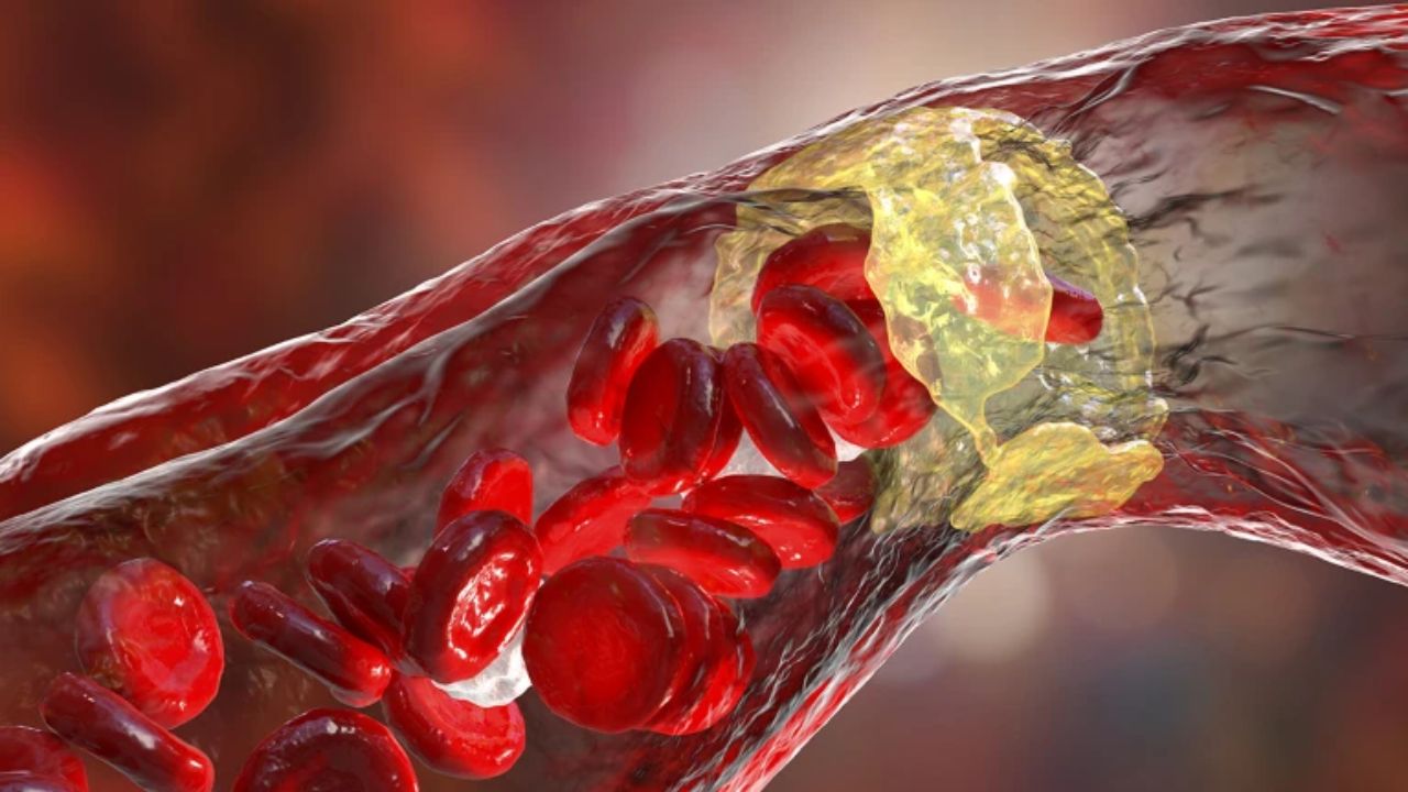 A Common Gut Bacterium Makes a Cholesterol-Lowering Compound That Shrank Artery Plaque in Mice