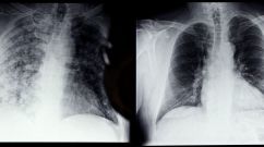 Lung infection