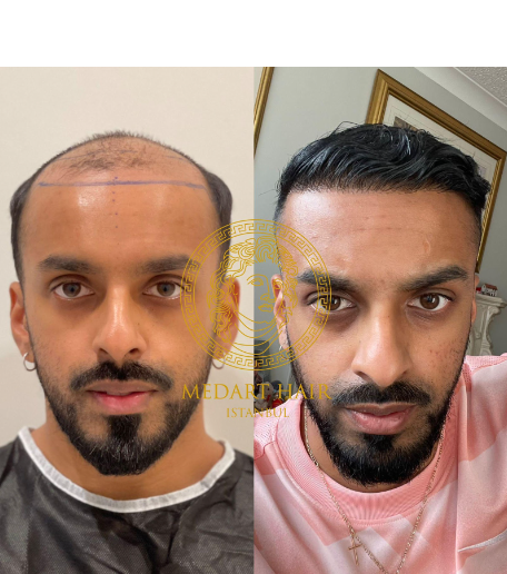 Medart Hair
